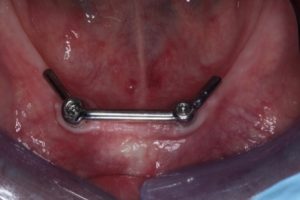 Situatie na: klikgebit onderkaak