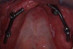 Situatie na: klikgebit bovenkaak