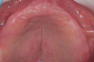 Situatie voor: vlakke kaak