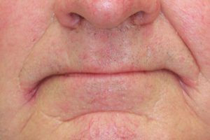 situatie voor: te lage beet