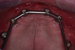 Situatie na: klikgebit in de bovenkaak