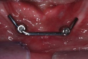 Situatie na: klikgebit in de onderkaak