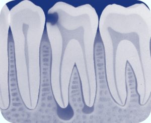 kies met een ontsteking