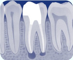 kies na de wortelkanaalbehandeling