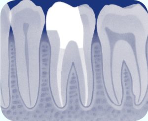 ontsteking van het wortelkanaal is genezen