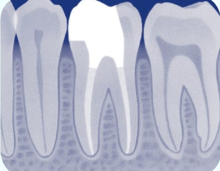 ontsteking van het wortelkanaal is genezen