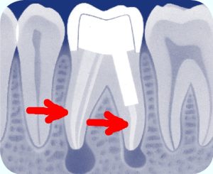 Situatie na de her-wortelkanaalbehandelingbehandeling