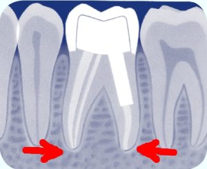 ontstoken wortelkanaal