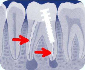 ontstoken wortelkanaal