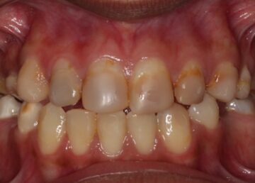 verkleurde vullingen en verkleurde tanden