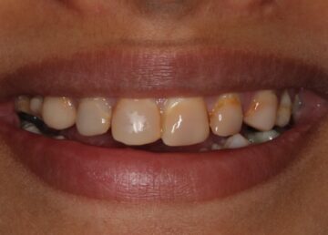 Situatie voor. De tanden zijn erg verkleurd en het vulmateriaal oogt niet fraai.