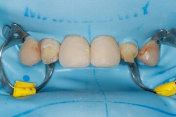 Tijdens behandeling wordt de tand geïsoleerd met een blauwkleurig rubber lapje. Zo kan onder vergroting het oude vulmateriaal voorzichtig verwijderd worden.