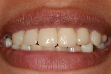 Situatie na. De tanden zijn netjes opgebouwd met composiet en zien er nu veel fraaier en frisser uit.