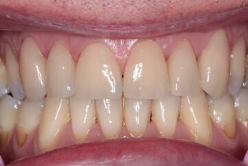 facings zijn geplaatst op de voortanden