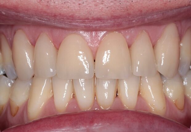 facings zijn geplaatst op de voortanden