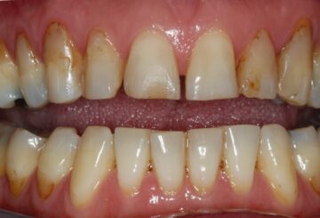 Patiënt is niet blij met het uiterlijk van de tanden