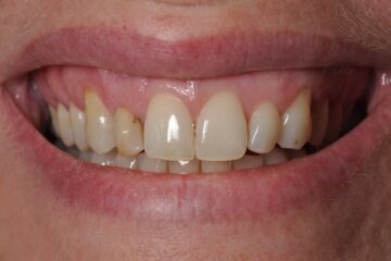 voor behandeling met een facing