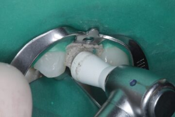 bewerken va de tand om de facing goed te laten hechten