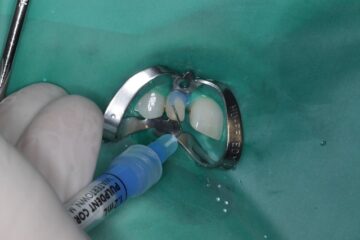 etsen van de tand om de facing goed te laten hechten