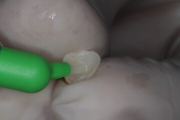 bewerken van de facing om deze te laten hechten aan de tand