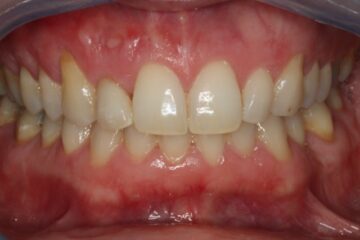 Na: eindresultaat met facing op de kleine voortand