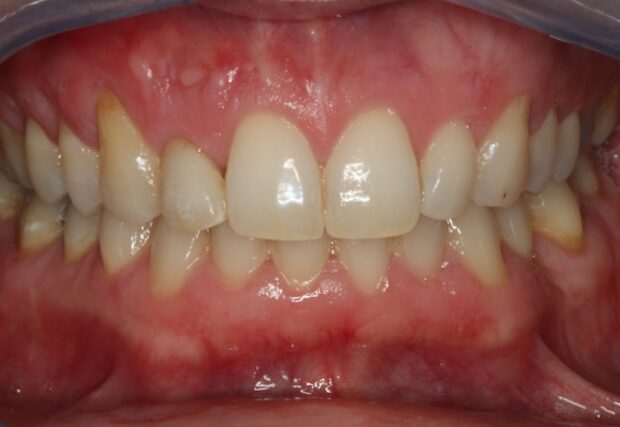 Na: eindresultaat met facing op de kleine voortand