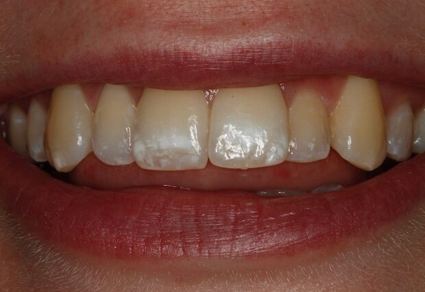 Witte vlek behandeling voortanden