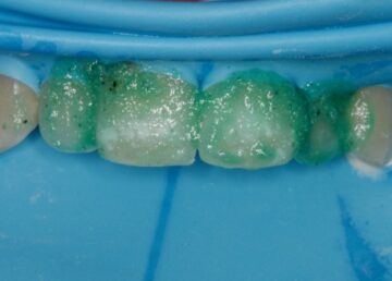 witte vlekken behandeling voortanden