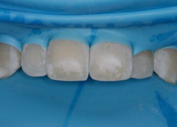 de tanden met vlekken zijn geïsoleerd met een rubber lapje