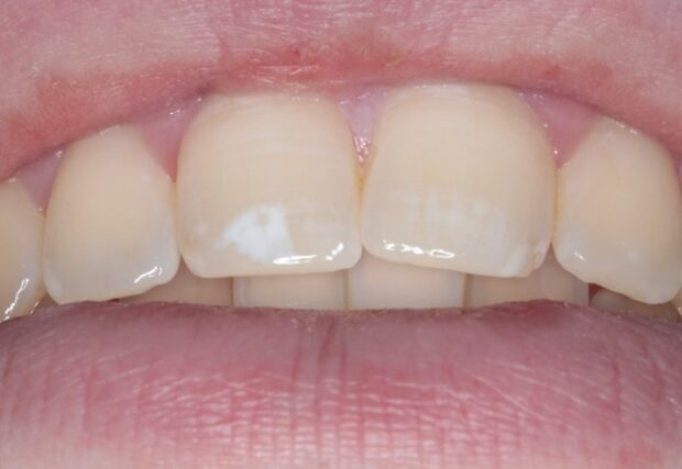 Witte vlek op de voortand