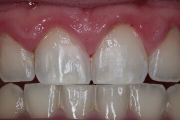 situatie na icon behandeling